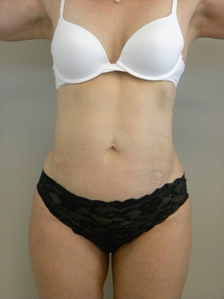 LIPOSUCTION BEFORE AND AFTER PICTURES IN MIAMI, FL