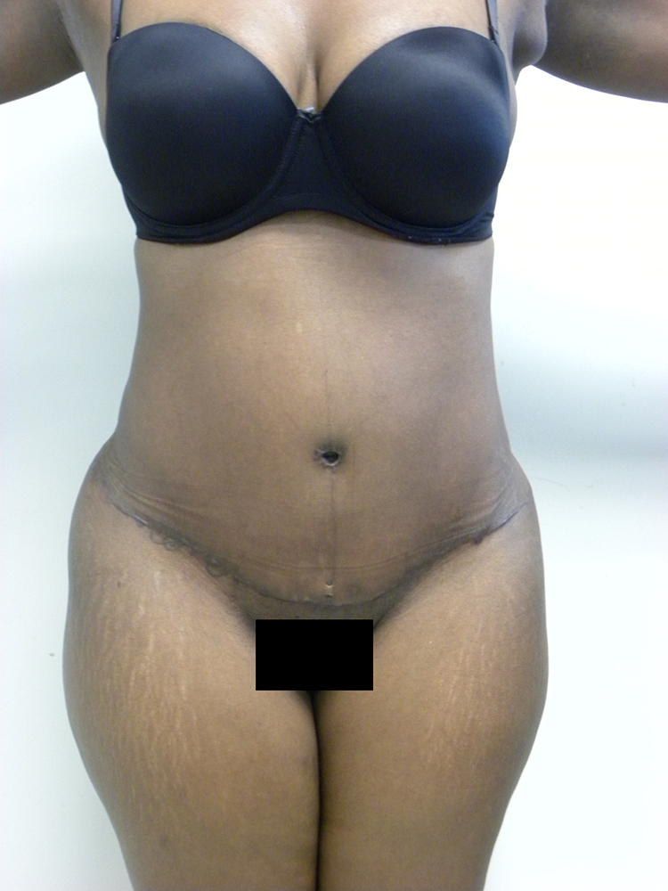 Tummy Tuck Before and After Pictures in Miami, FL