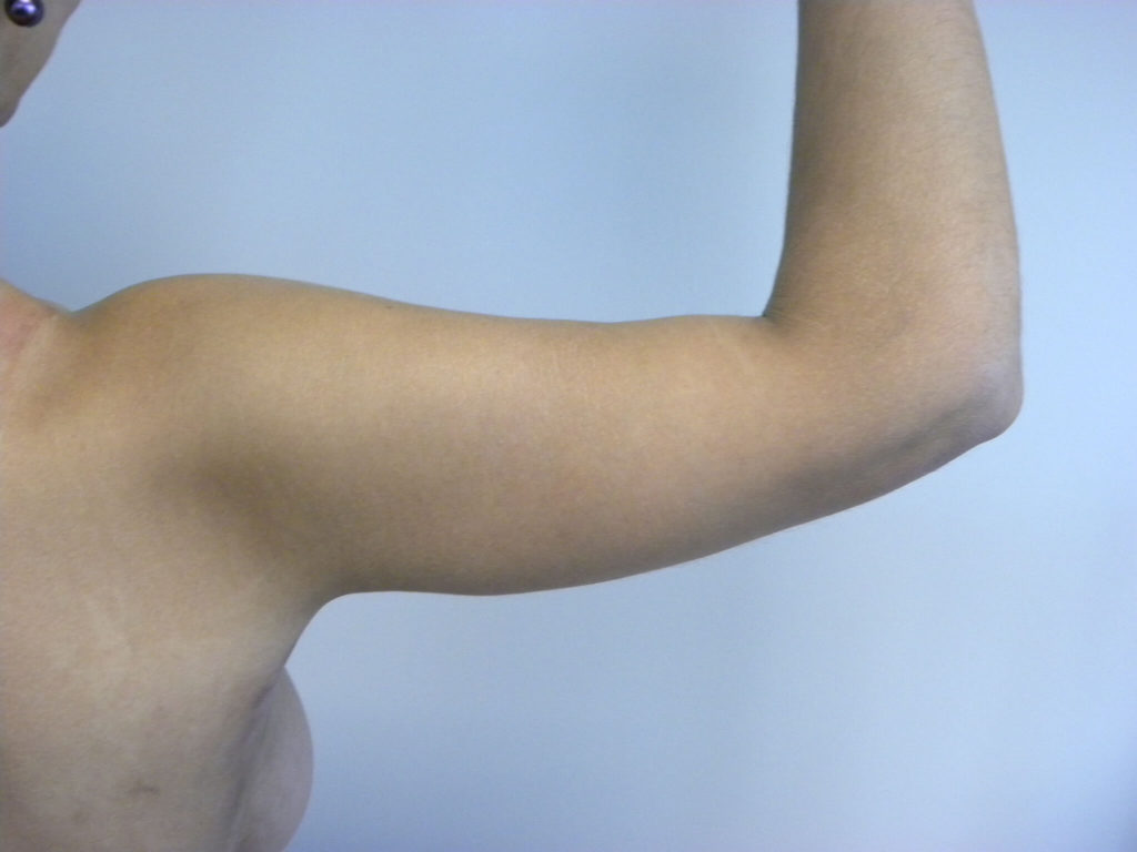 Arm Lift Before and After Pictures Miami, FL