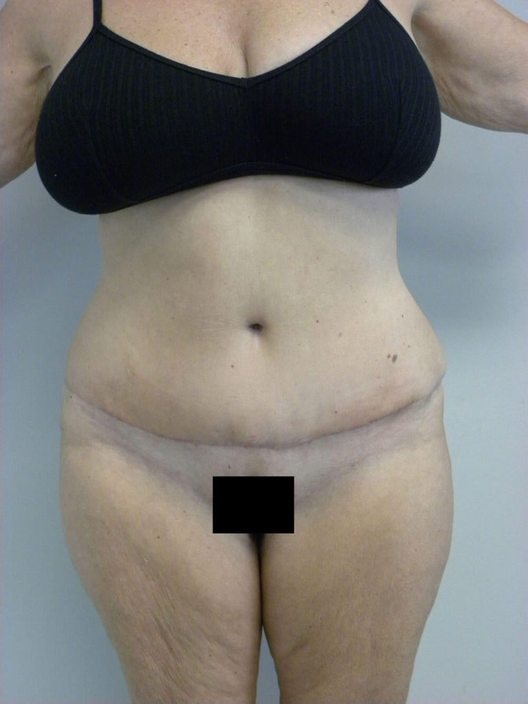 Tummy Tuck Before and After Pictures in Miami, FL