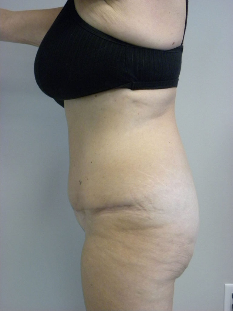 Tummy Tuck Before and After Pictures in Miami, FL