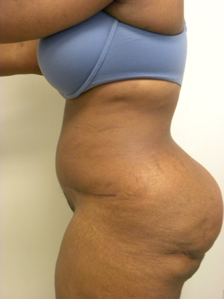 Tummy Tuck Before and After Pictures in Miami, FL