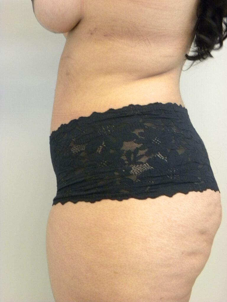 Tummy Tuck Before and After Pictures in Miami, FL