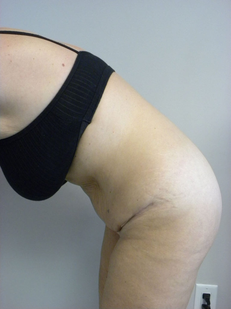 Tummy Tuck Before and After Pictures in Miami, FL