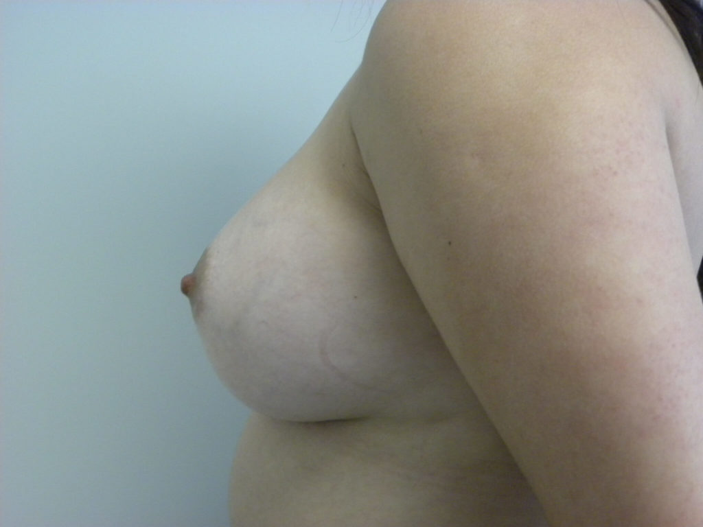 Breast Augmentation Before and After Pictures in Miami, FL