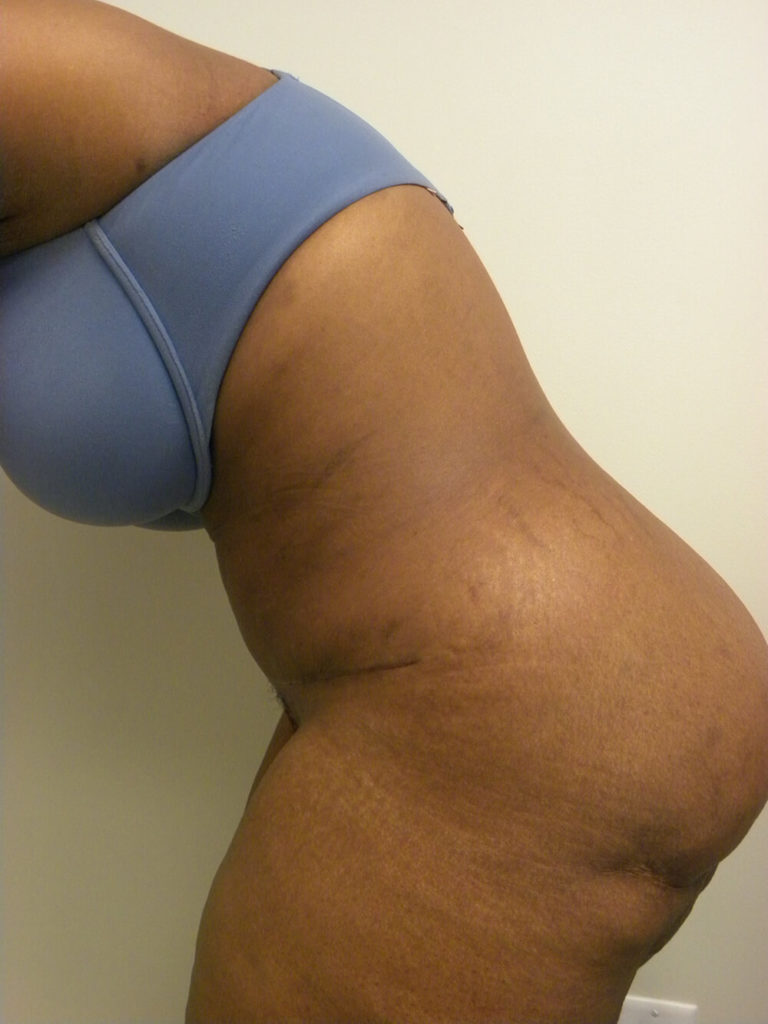 Tummy Tuck Before and After Pictures in Miami, FL