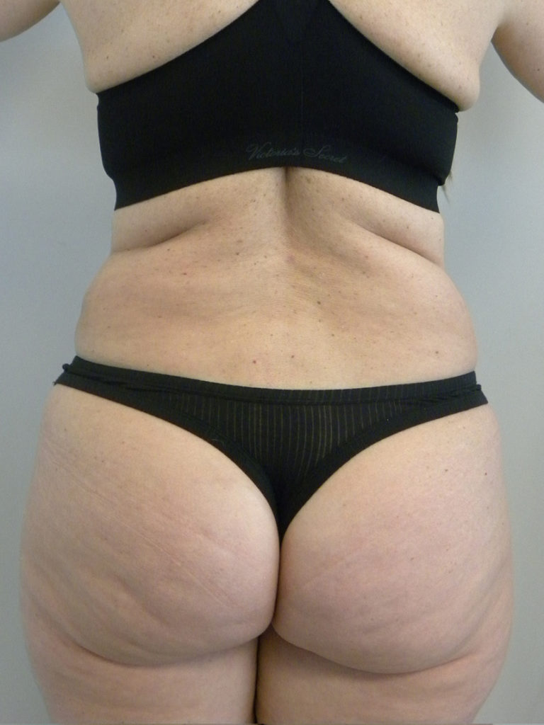 Liposuction Before and After Pictures Miami, FL