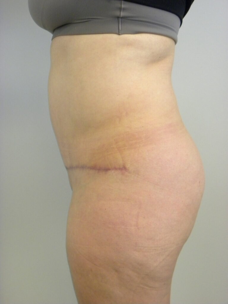 Plastic Surgery Before and After Pictures in Miami, FL - Dr. Adam J. Rubinstein 