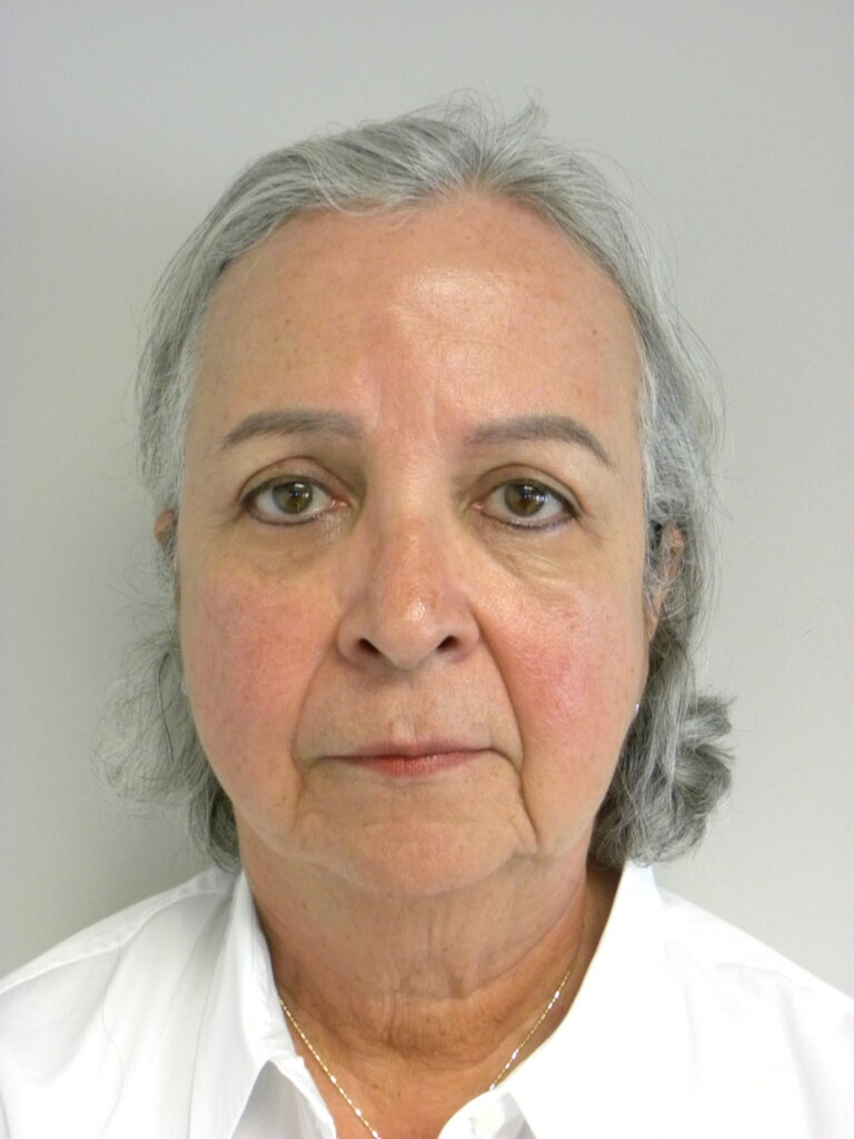 Plastic Surgery Before and After Pictures in Miami, FL - Dr. Adam J. Rubinstein 