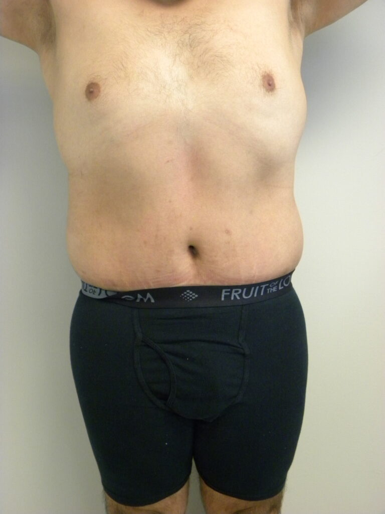 Plastic Surgery Before and After Pictures in Miami, FL - Dr. Adam J. Rubinstein 