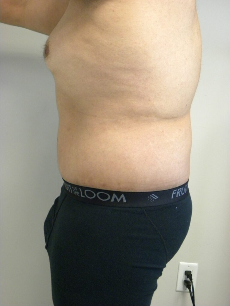 Plastic Surgery Before and After Pictures in Miami, FL - Dr. Adam J. Rubinstein 