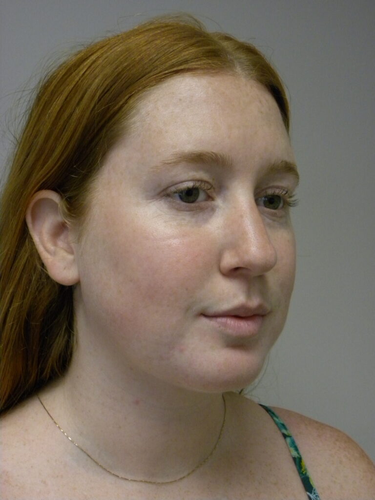 Plastic Surgery Before and After Pictures in Miami, FL - Dr. Adam J. Rubinstein 