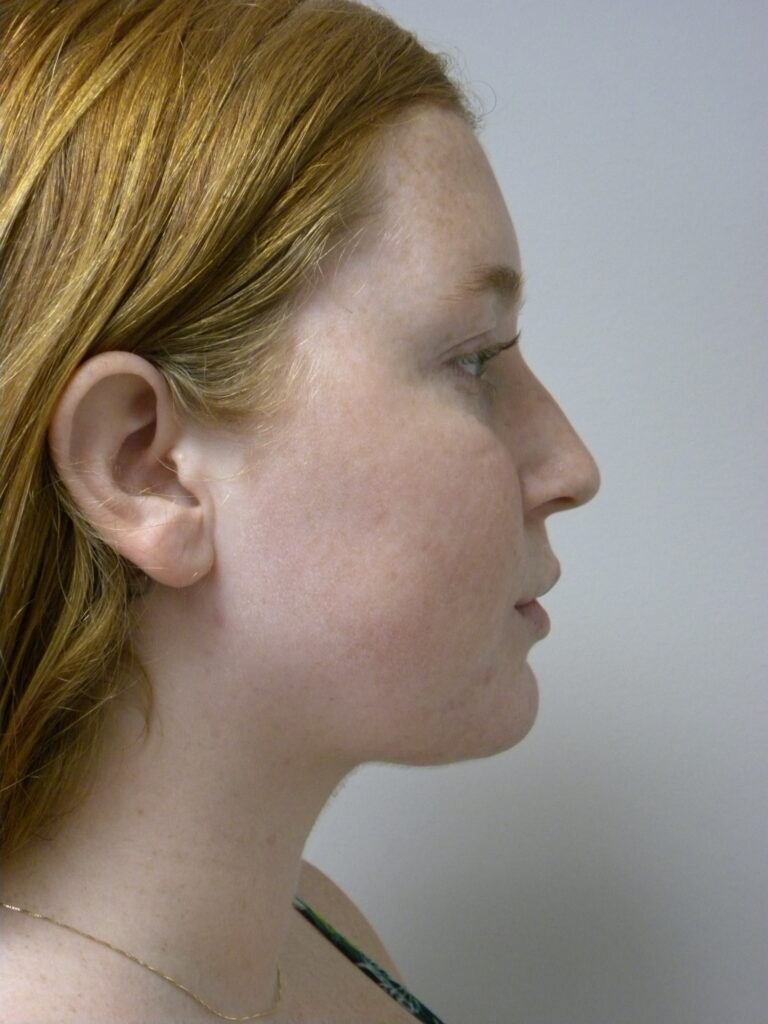 Plastic Surgery Before and After Pictures in Miami, FL - Dr. Adam J. Rubinstein 