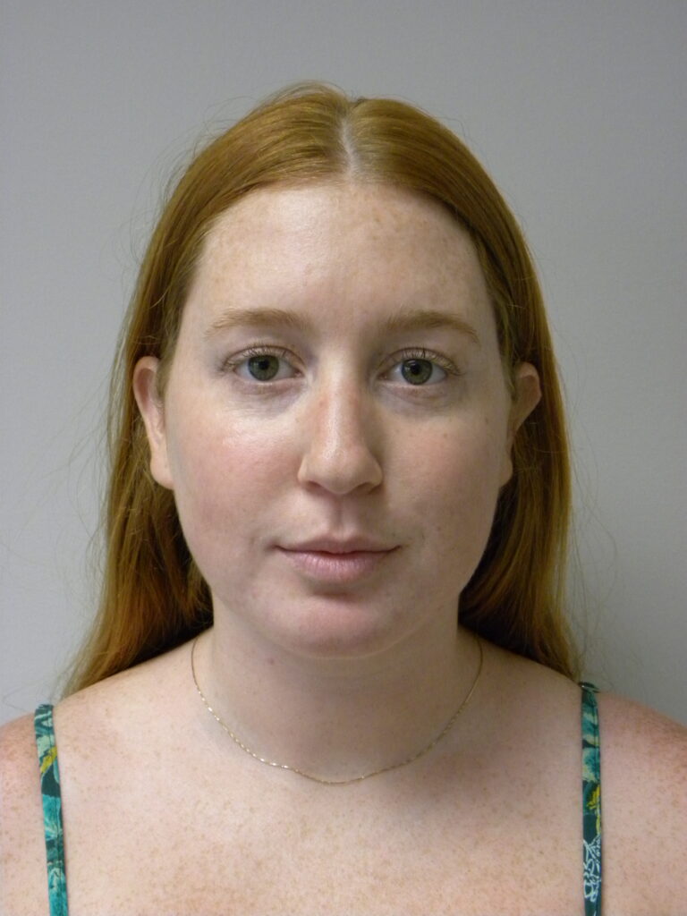 Plastic Surgery Before and After Pictures in Miami, FL - Dr. Adam J. Rubinstein 