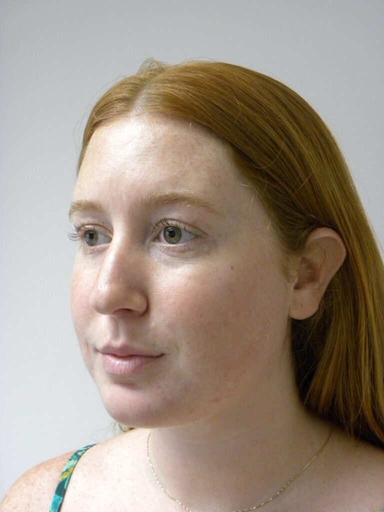 Plastic Surgery Before and After Pictures in Miami, FL - Dr. Adam J. Rubinstein 