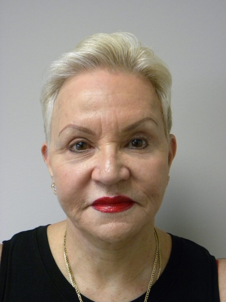 Plastic Surgery Before and After Pictures in Miami, FL - Dr. Adam J. Rubinstein 