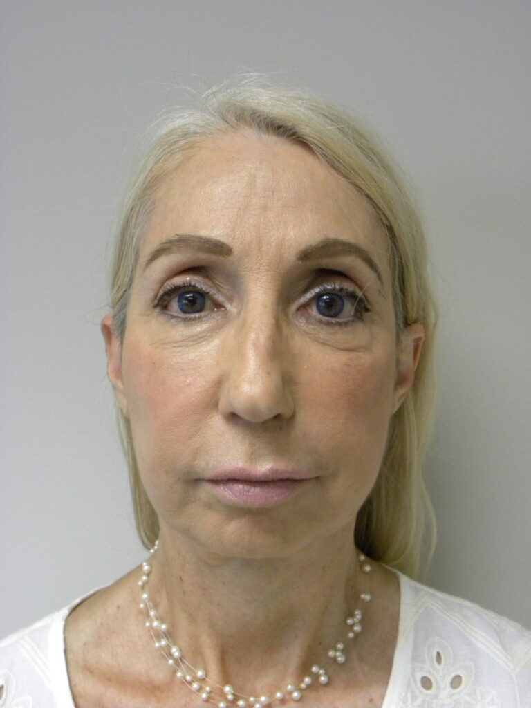 Plastic Surgery Before and After Pictures in Miami, FL - Dr. Adam J. Rubinstein 