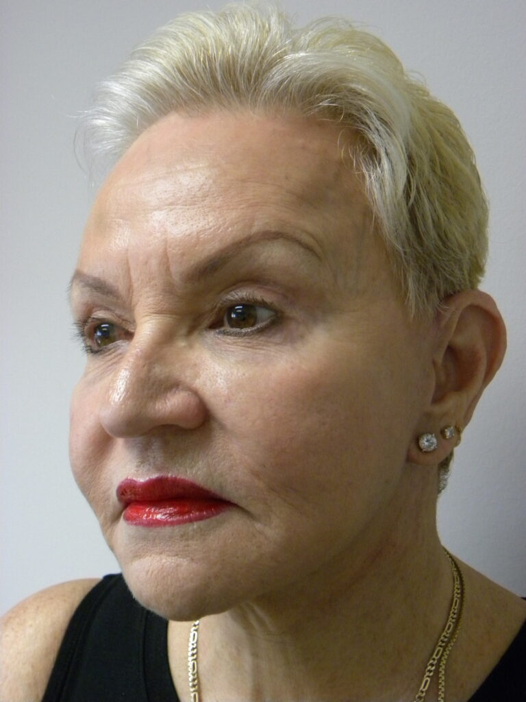 Plastic Surgery Before and After Pictures in Miami, FL - Dr. Adam J. Rubinstein 