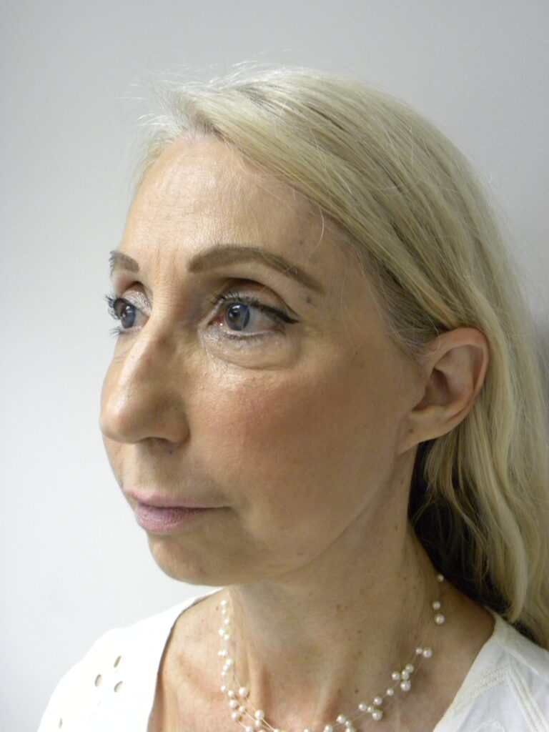 Plastic Surgery Before and After Pictures in Miami, FL - Dr. Adam J. Rubinstein 