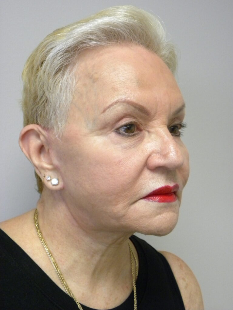 Plastic Surgery Before and After Pictures in Miami, FL - Dr. Adam J. Rubinstein 