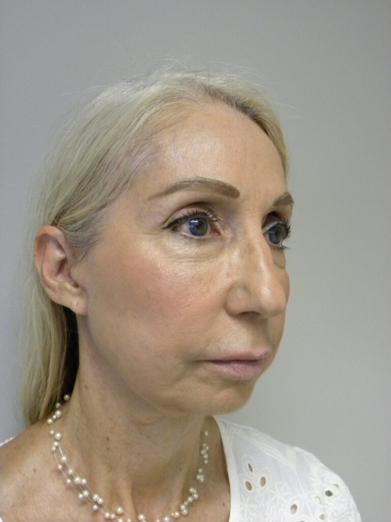 Plastic Surgery Before and After Pictures in Miami, FL - Dr. Adam J. Rubinstein 