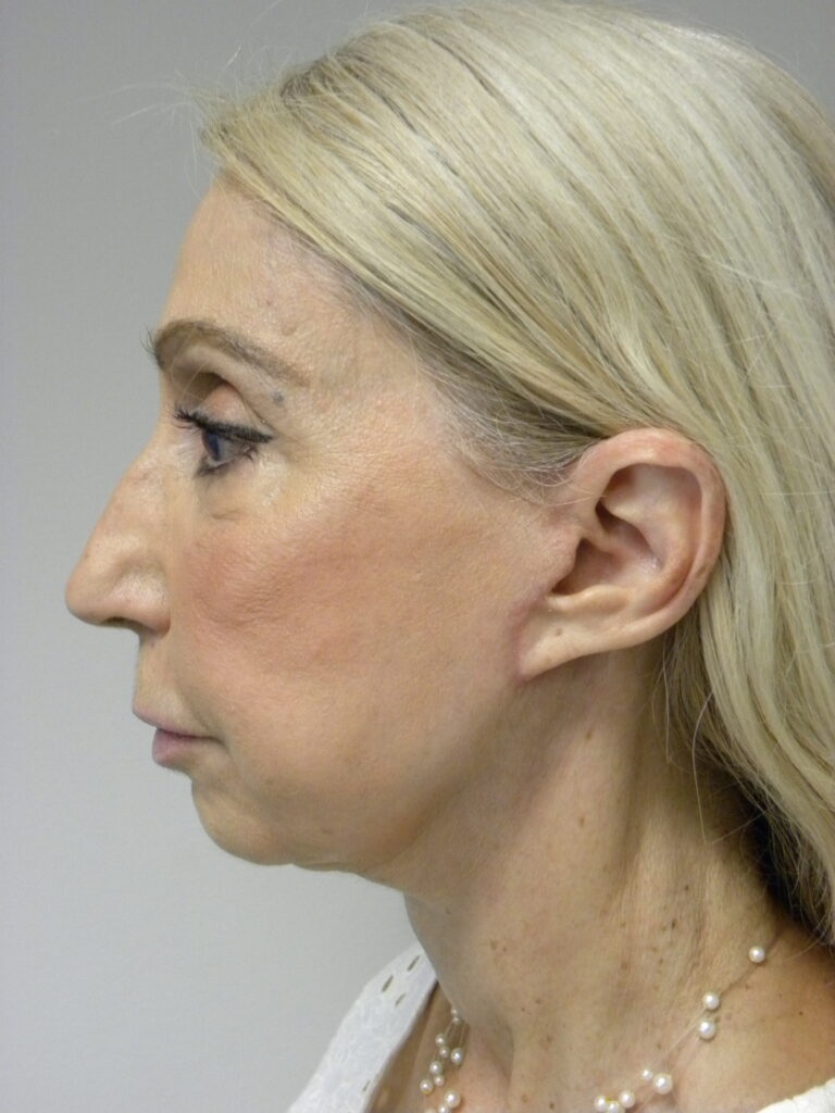 Plastic Surgery Before and After Pictures in Miami, FL - Dr. Adam J. Rubinstein 