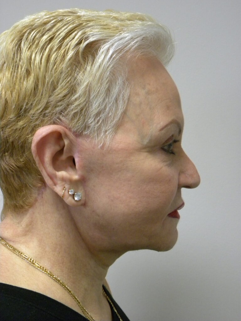 Plastic Surgery Before and After Pictures in Miami, FL - Dr. Adam J. Rubinstein 