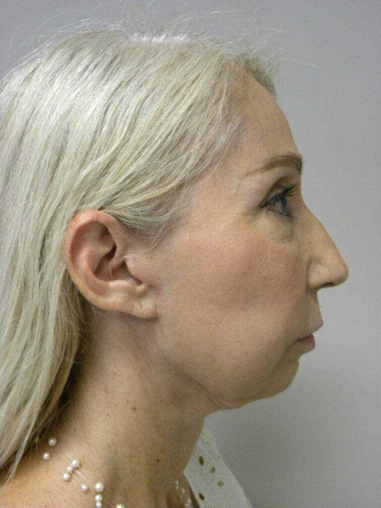 Plastic Surgery Before and After Pictures in Miami, FL - Dr. Adam J. Rubinstein 