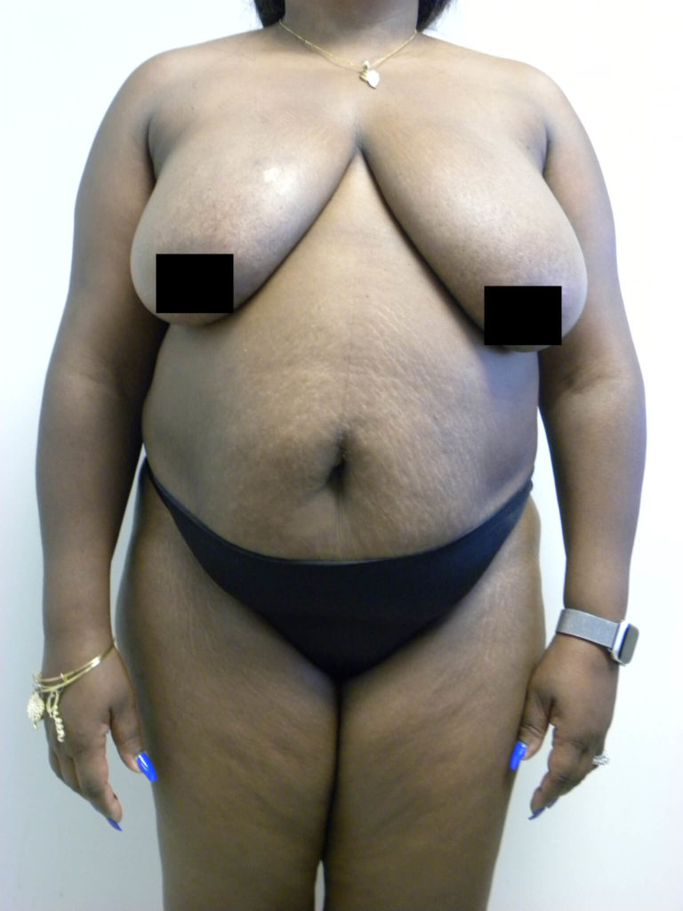 Tummy Tuck Before and After Pictures Miami, FL