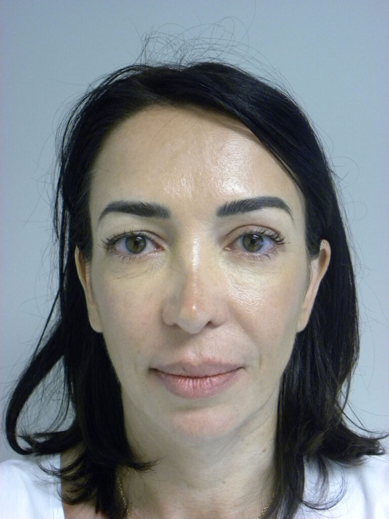 BLEPHAROPLASTY BEFORE AND AFTER PICTURES IN MIAMI, FL