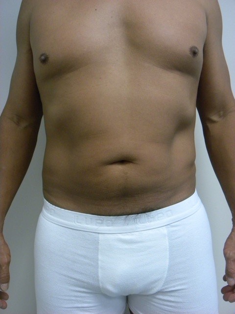 LIPOSUCTION BEFORE AND AFTER PICTURES IN MIAMI, FL