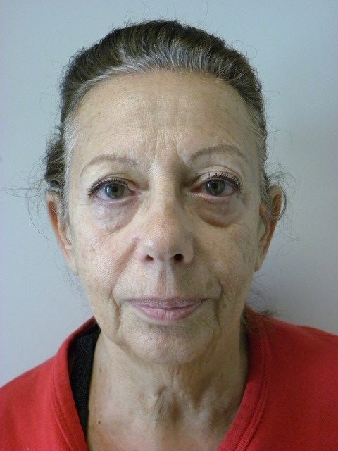 Facelift Before and After Pictures in Miami, FL