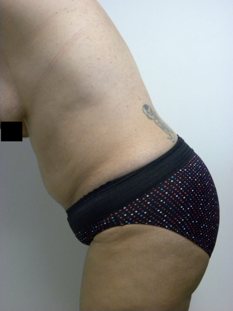 Tummy Tuck Before and After Pictures in Miami, FL