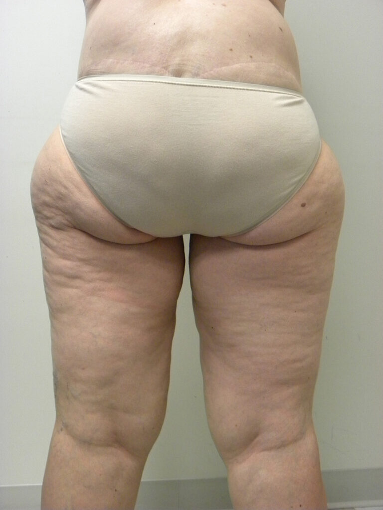 Thigh Lift Before and After Pictures in Miami, FL