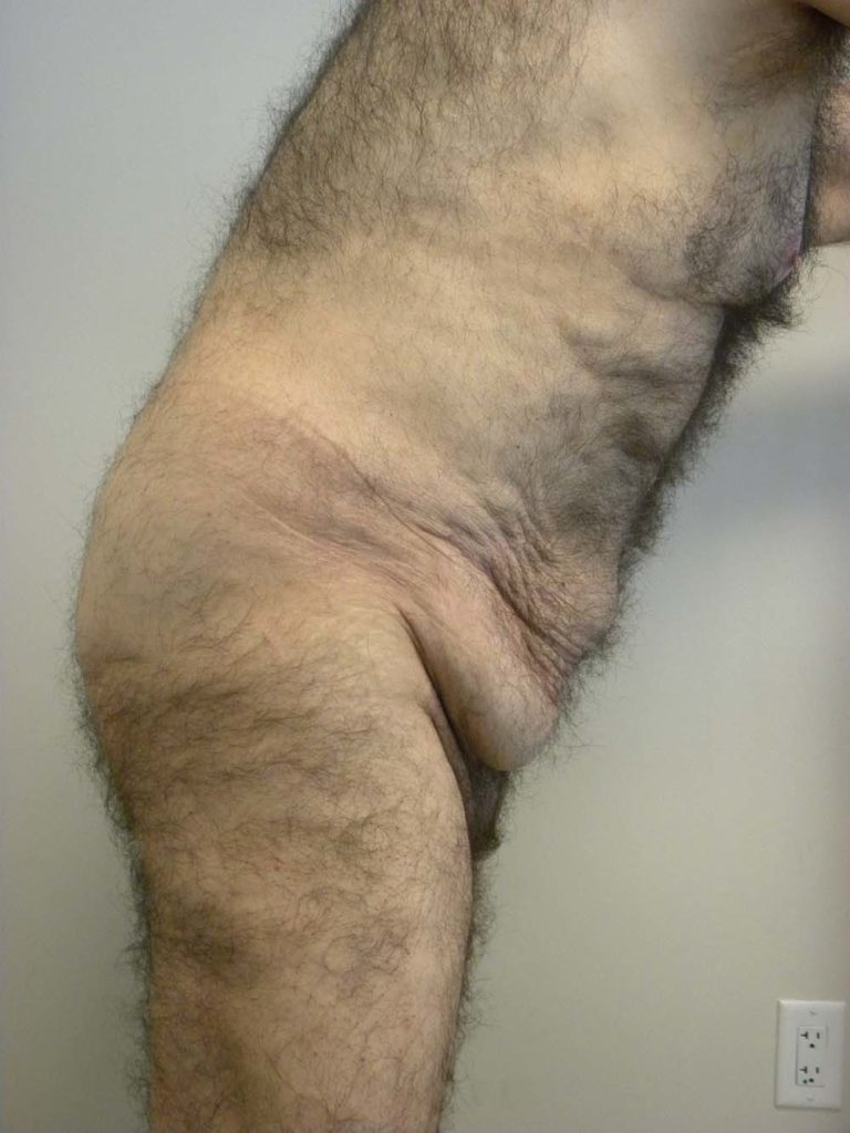 Plastic Surgery Before and After Pictures in Miami, FL - Dr. Adam J. Rubinstein 
