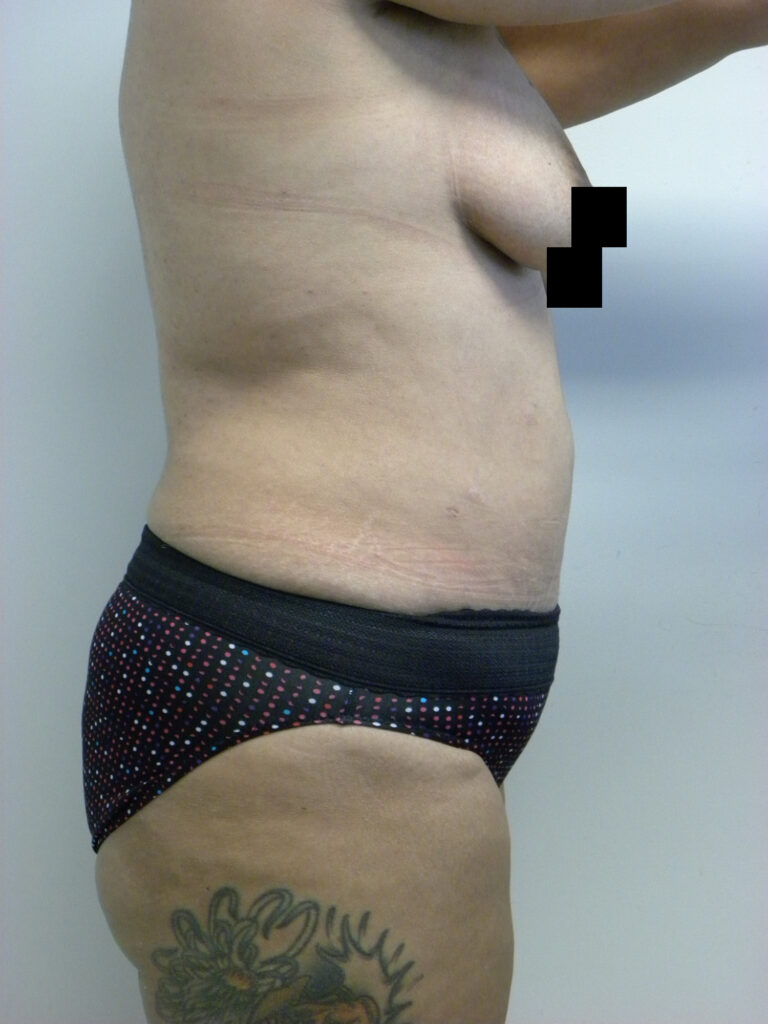 Tummy Tuck Before and After Pictures Miami, FL