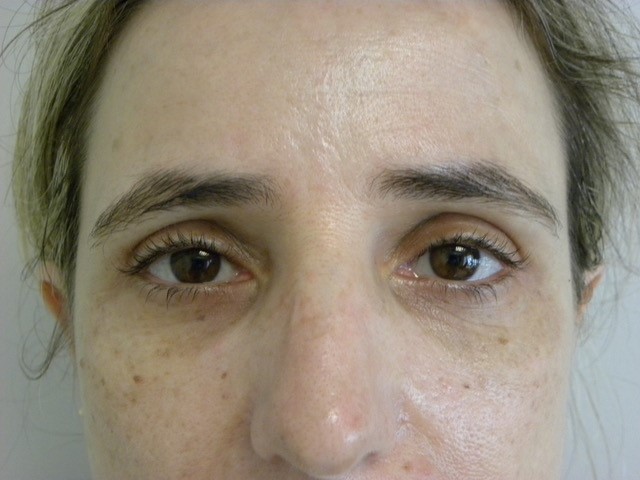 Blepharoplasty Before and After Pictures in Miami, FL