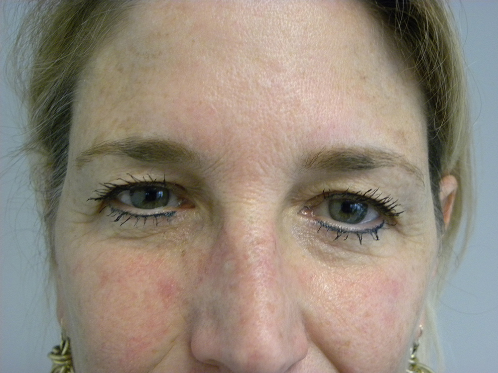 BLEPHAROPLASTY BEFORE AND AFTER PICTURES IN MIAMI, FL