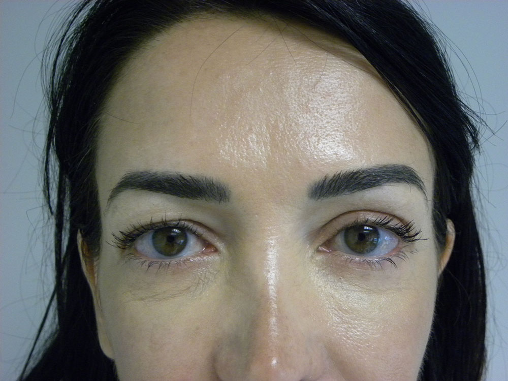 BLEPHAROPLASTY BEFORE AND AFTER PICTURES IN MIAMI, FL