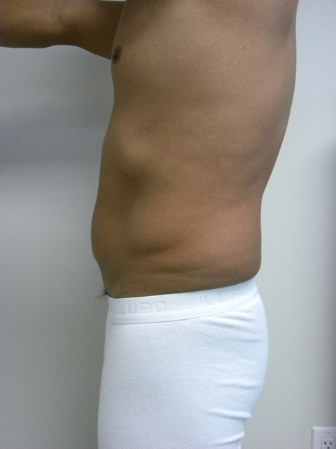 LIPOSUCTION BEFORE AND AFTER PICTURES IN MIAMI, FL