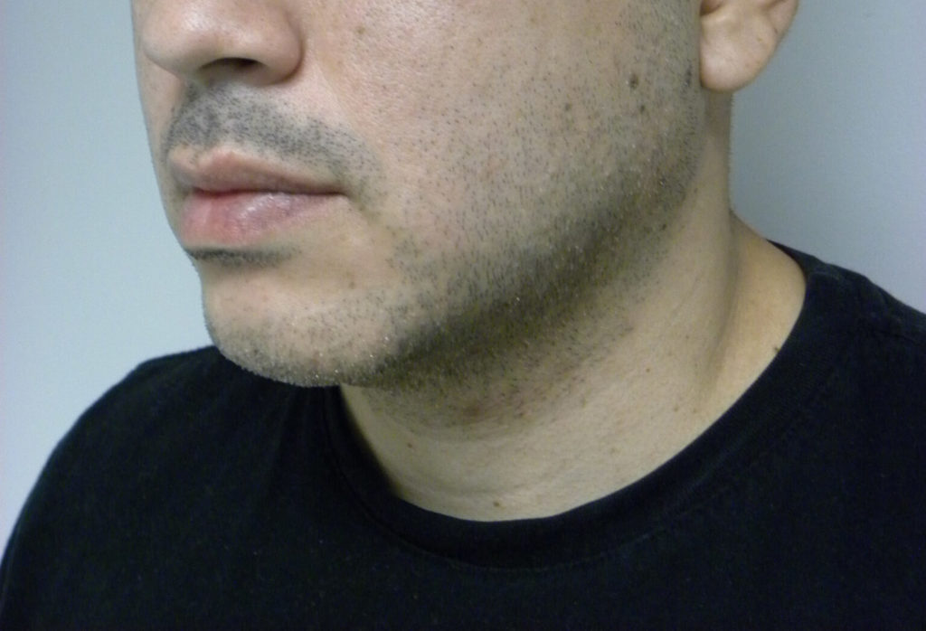 CHIN IMPLANT BEFORE AND AFTER PICTURES IN MIAMI, FL