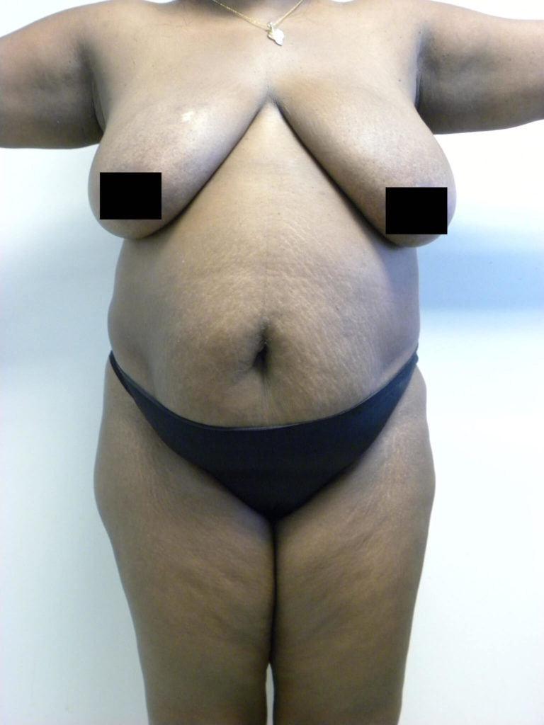 Tummy Tuck Before and After Pictures Miami, FL