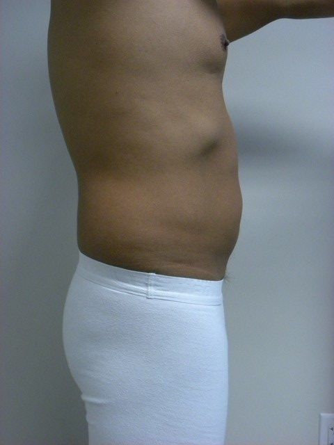 LIPOSUCTION BEFORE AND AFTER PICTURES IN MIAMI, FL