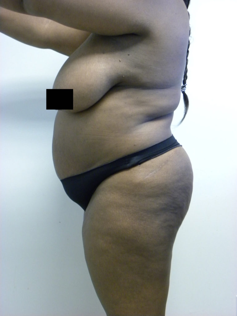 Tummy Tuck Before and After Pictures Miami, FL