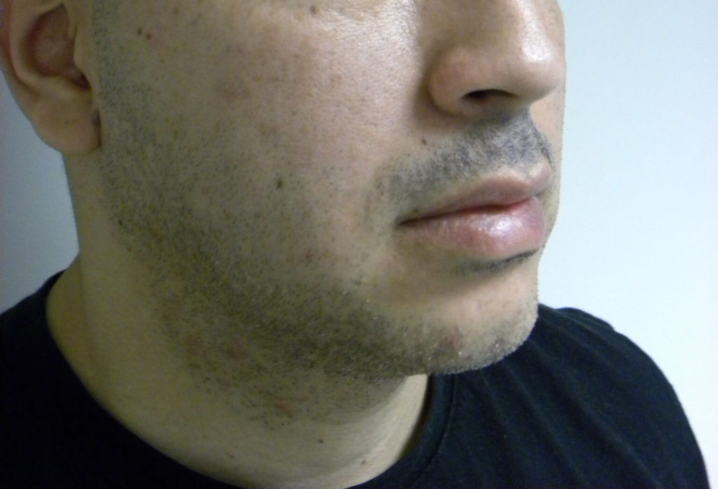 CHIN IMPLANT BEFORE AND AFTER PICTURES IN MIAMI, FL