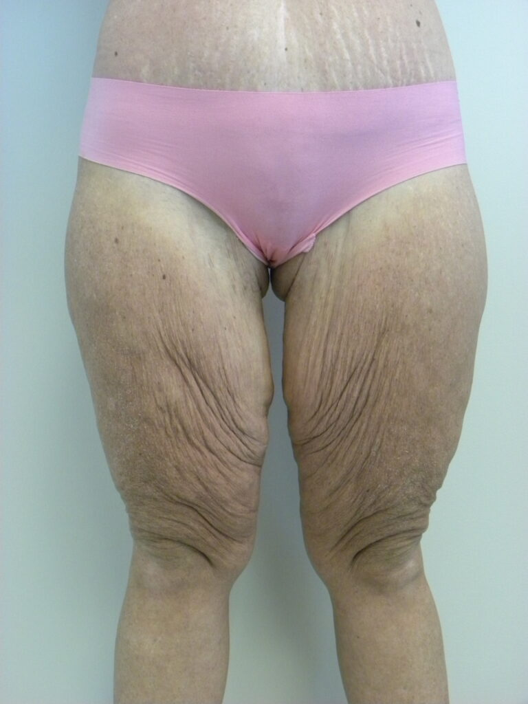 Thigh Lift Before and After Pictures in Miami, FL