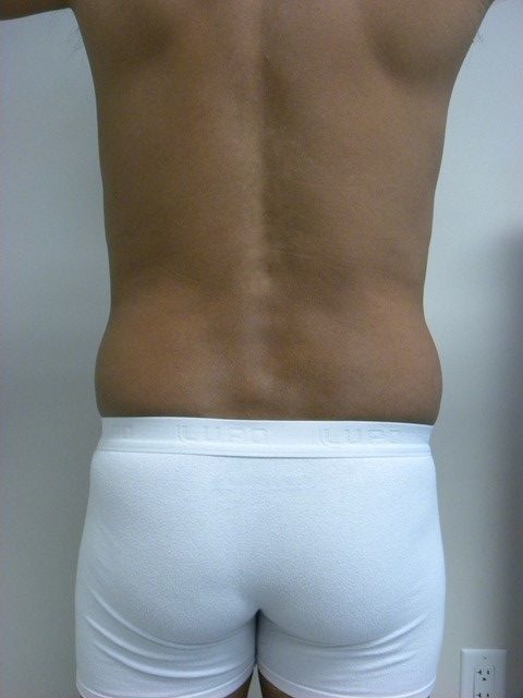 LIPOSUCTION BEFORE AND AFTER PICTURES IN MIAMI, FL