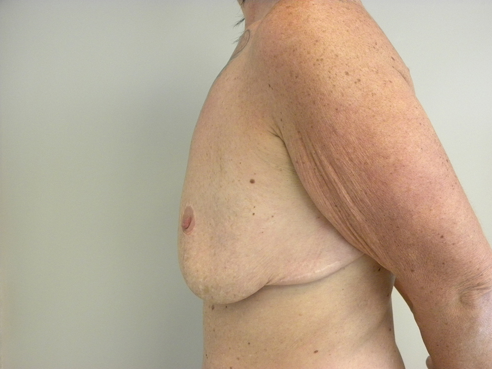 Breast Lift and Augmentation Before and After Pictures in Miami, FL