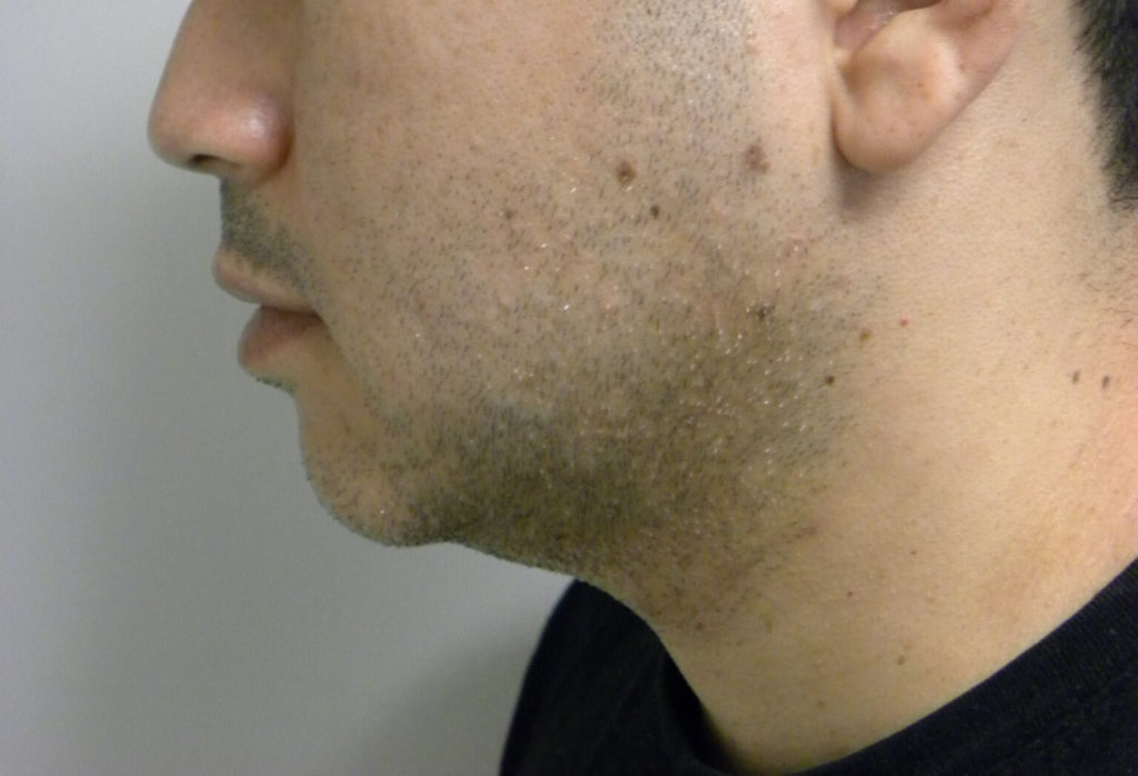 CHIN IMPLANT BEFORE AND AFTER PICTURES IN MIAMI, FL