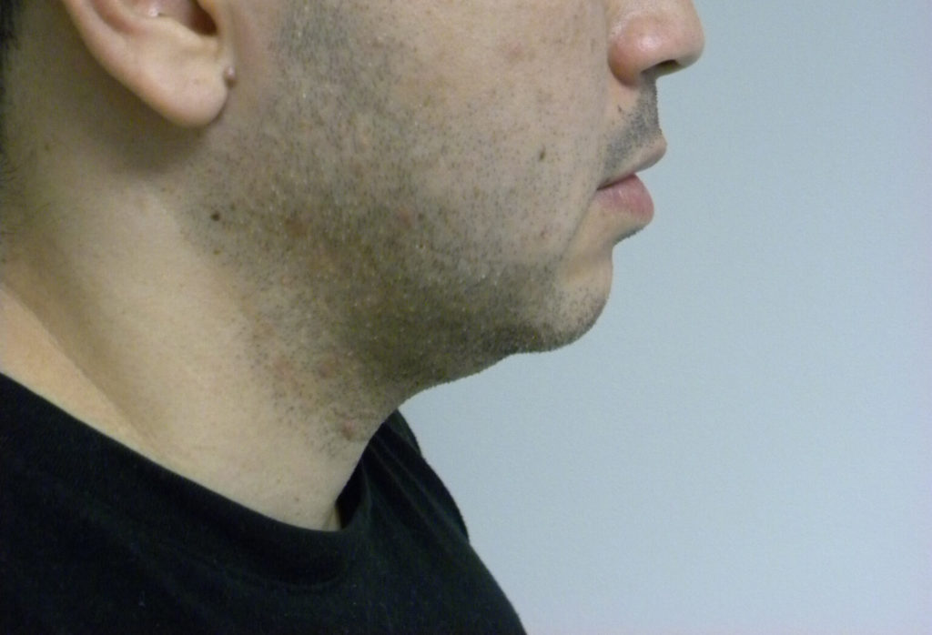 CHIN IMPLANT BEFORE AND AFTER PICTURES IN MIAMI, FL